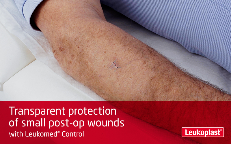 This film shows the use of a transparent wound dressing: we see the hands of an HCP covering a small surgical incision on a patient's forearm with Leukomed Control.  This film shows the use of a transparent wound dressing: we see the hands of an HCP covering a small surgical incision on a patient's forearm with Leukomed Control.